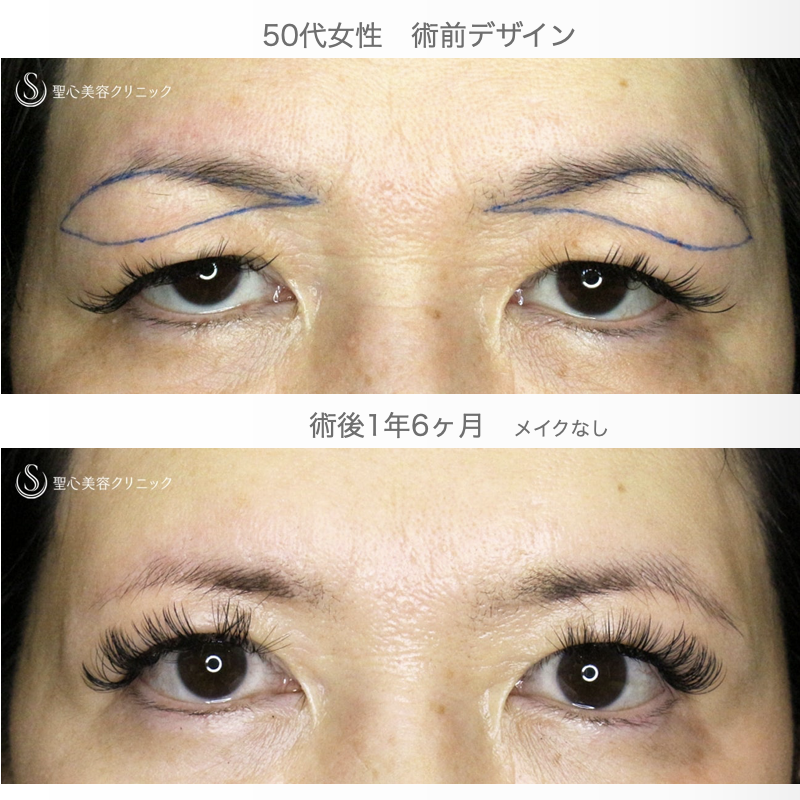 【50代女性・劇的ビフォーアフター】眉下リフト+α単独（1年6ヶ月後） After 