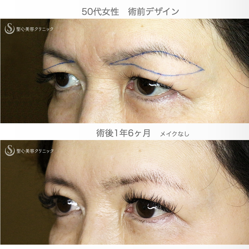 【50代女性・劇的ビフォーアフター】眉下リフト+α単独（1年6ヶ月後） After 