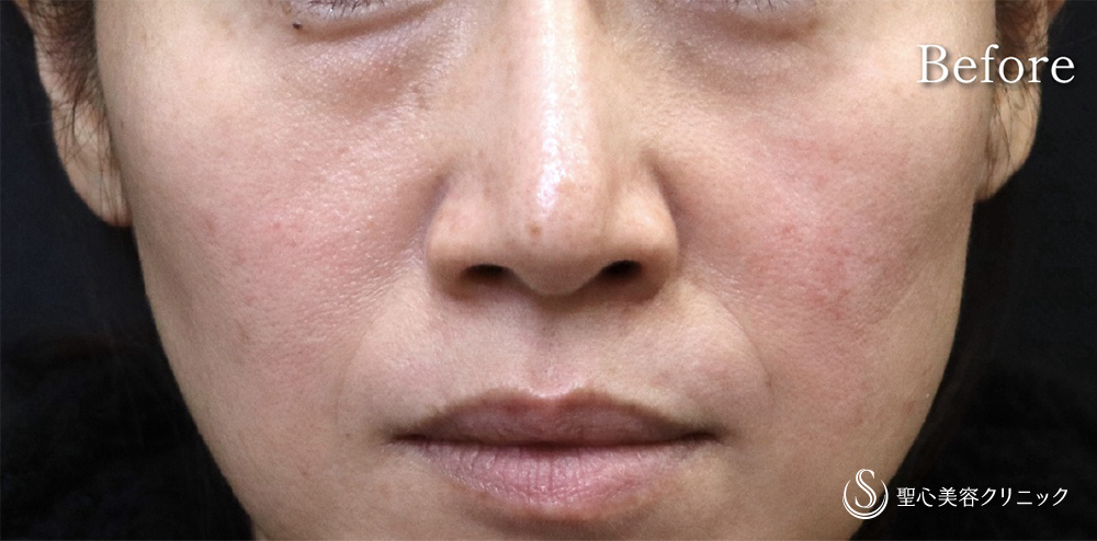 【40代女性・目の下・ほうれい線】プレミアムPRP皮膚再生療法（1年後） Before 