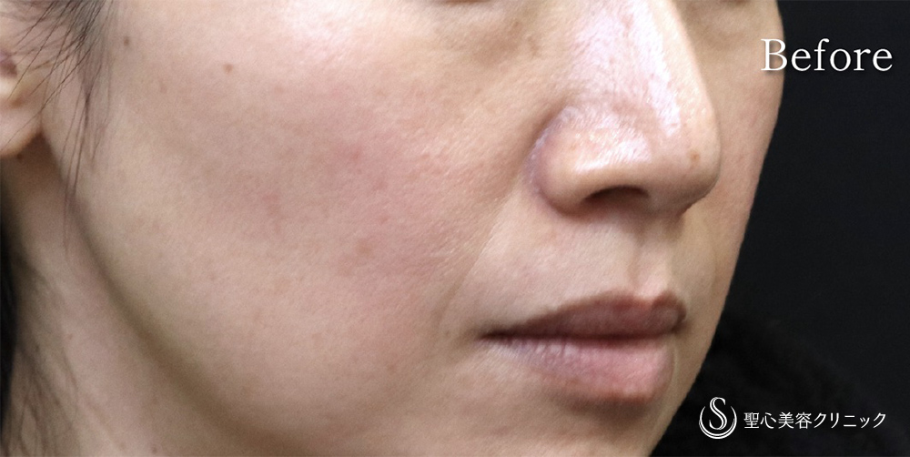 【40代女性・目の下・ほうれい線】プレミアムPRP皮膚再生療法（1年後） Before 