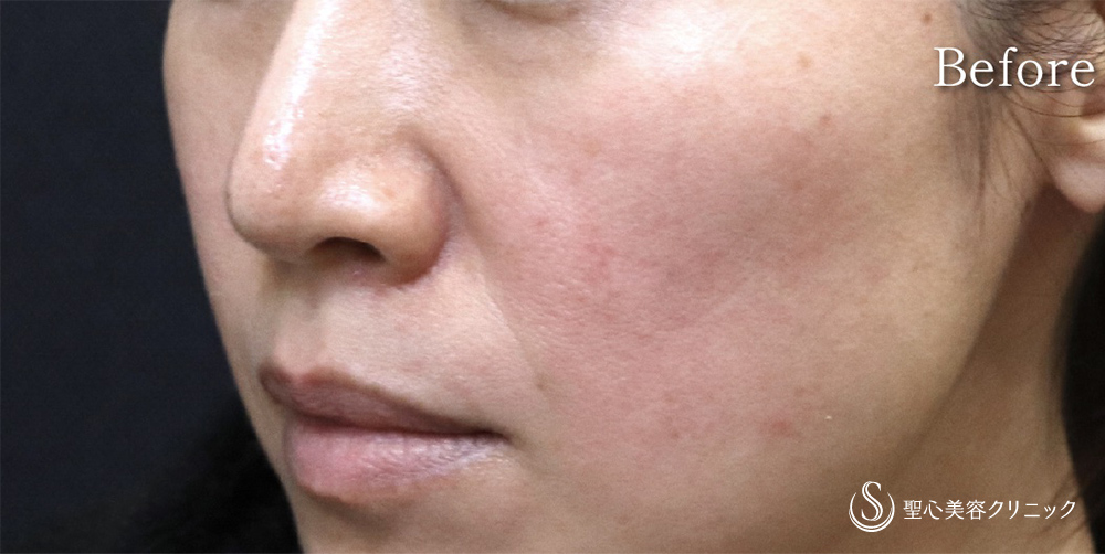 【40代女性・目の下・ほうれい線】プレミアムPRP皮膚再生療法（1年後） Before 