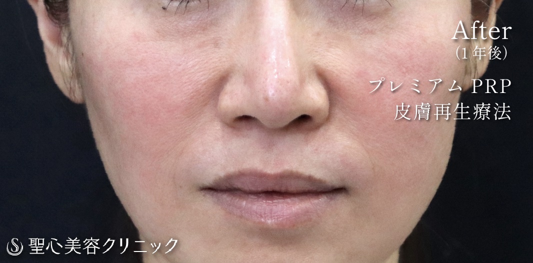 【40代女性・目の下・ほうれい線】プレミアムPRP皮膚再生療法（1年後） After 