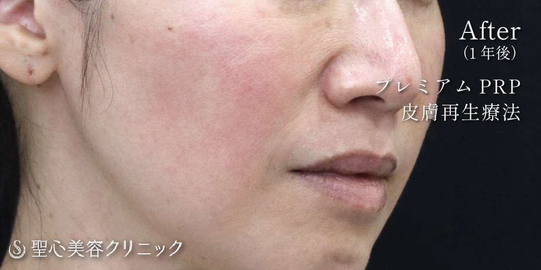 【40代女性・目の下・ほうれい線】プレミアムPRP皮膚再生療法（1年後） After 
