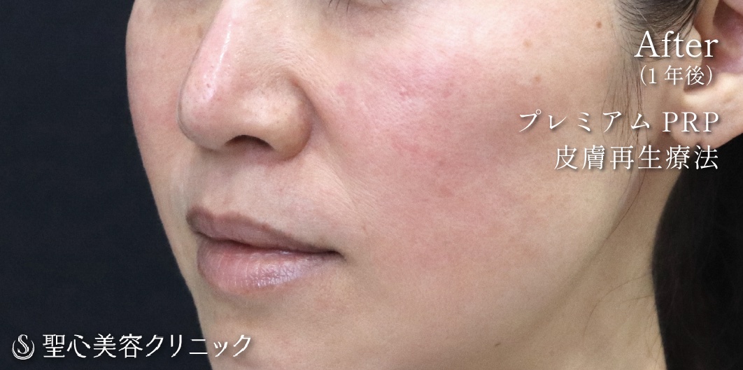 【40代女性・目の下・ほうれい線】プレミアムPRP皮膚再生療法（1年後） After 