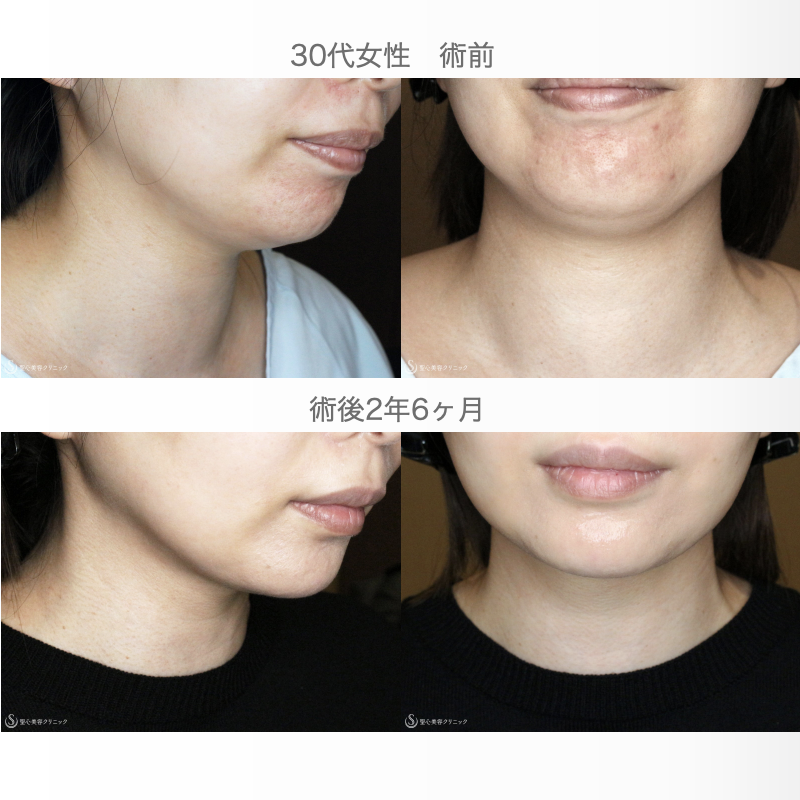 【30代女性・シリンジ吸引で二重あご解消】脂肪吸引注射「あご下」（術直後〜2年半後） After 