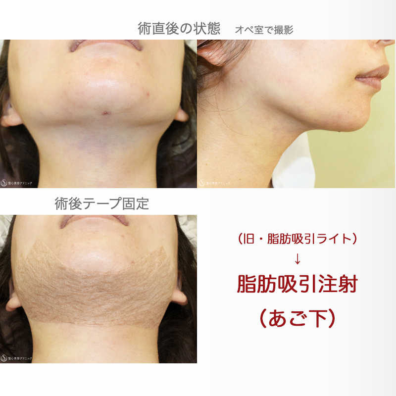 【30代女性・シリンジ吸引で二重あご解消】脂肪吸引注射「あご下」（術直後〜2年半後） After 