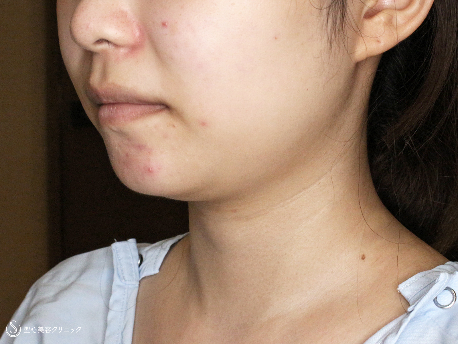 【20代女性・下ぶくれ＆二重あご解消】ベイザー脂肪吸引「頬＆あご下」（直後〜2ヶ月後） Before 