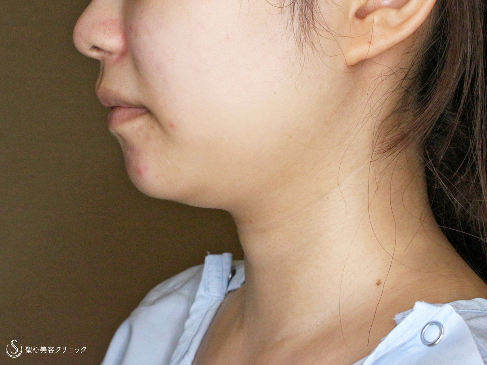 【20代女性・下ぶくれ＆二重あご解消】ベイザー脂肪吸引「頬＆あご下」（直後〜2ヶ月後） Before 