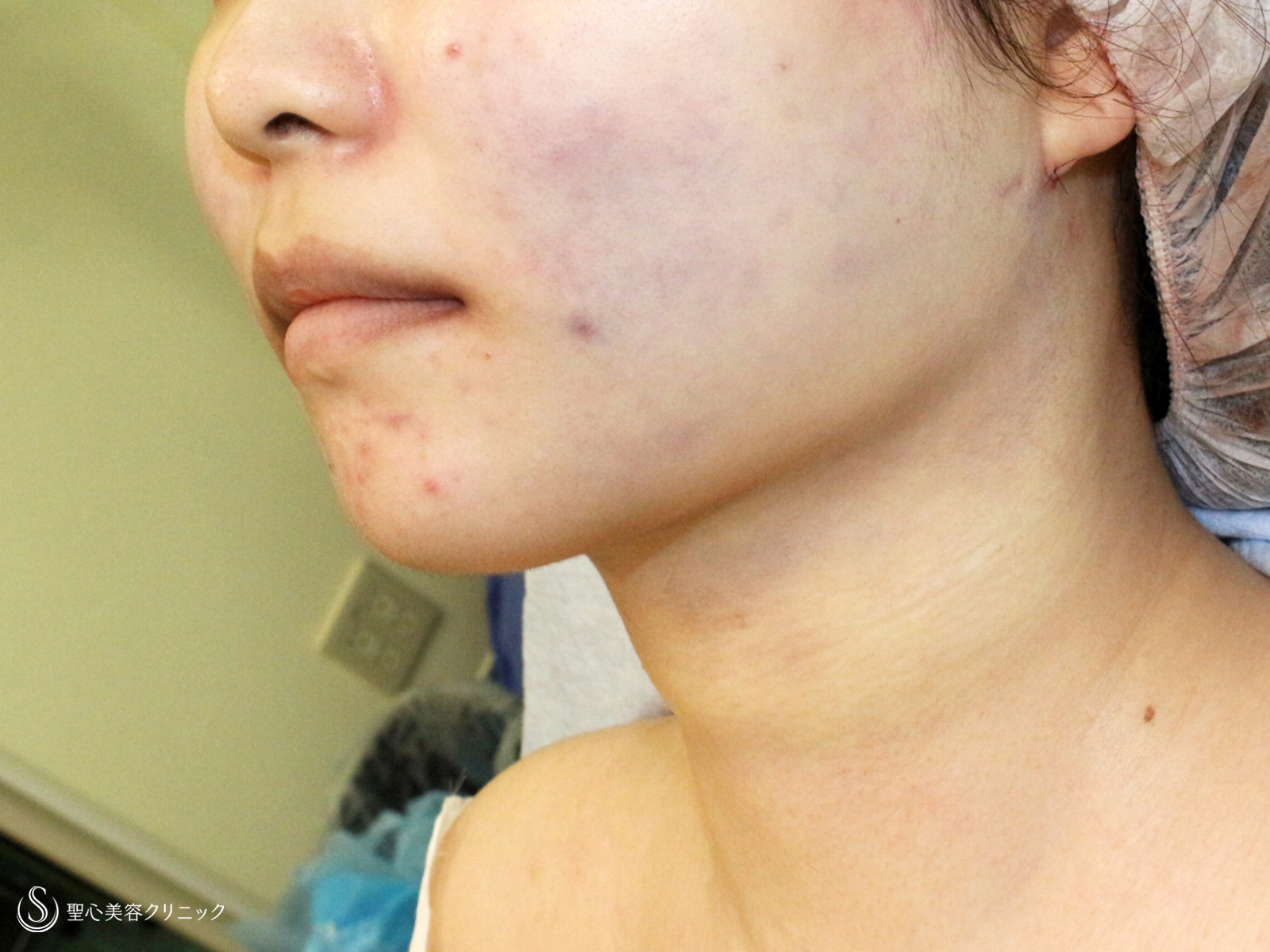 【20代女性・下ぶくれ＆二重あご解消】ベイザー脂肪吸引「頬＆あご下」（直後〜2ヶ月後） Before 