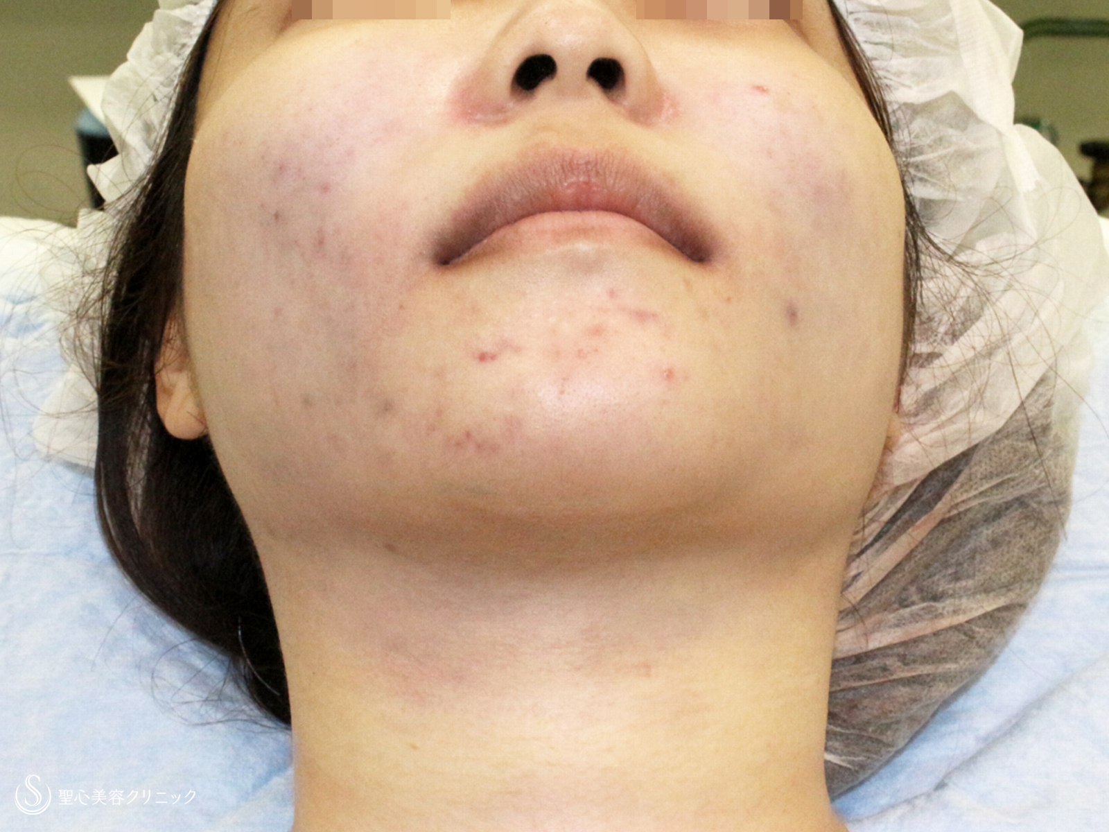 【20代女性・下ぶくれ＆二重あご解消】ベイザー脂肪吸引「頬＆あご下」（直後〜2ヶ月後） Before 