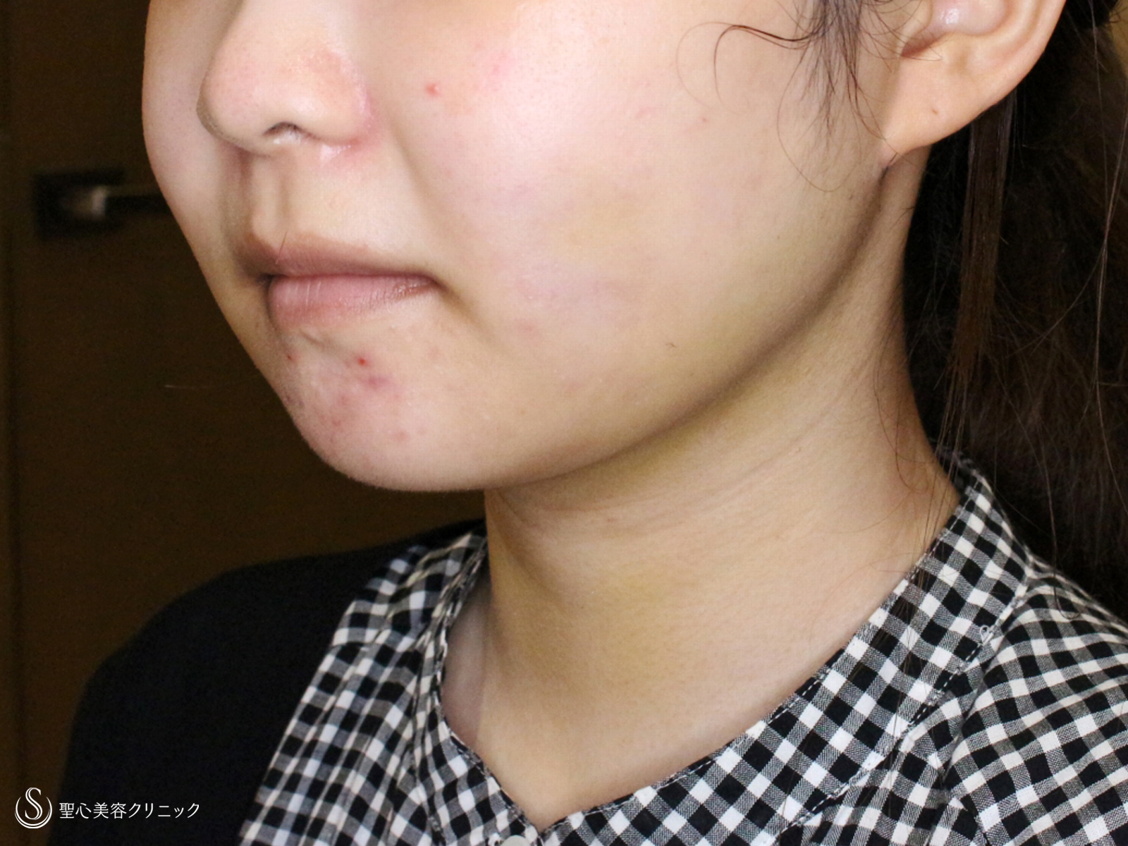 【20代女性・下ぶくれ＆二重あご解消】ベイザー脂肪吸引「頬＆あご下」（直後〜2ヶ月後） After 