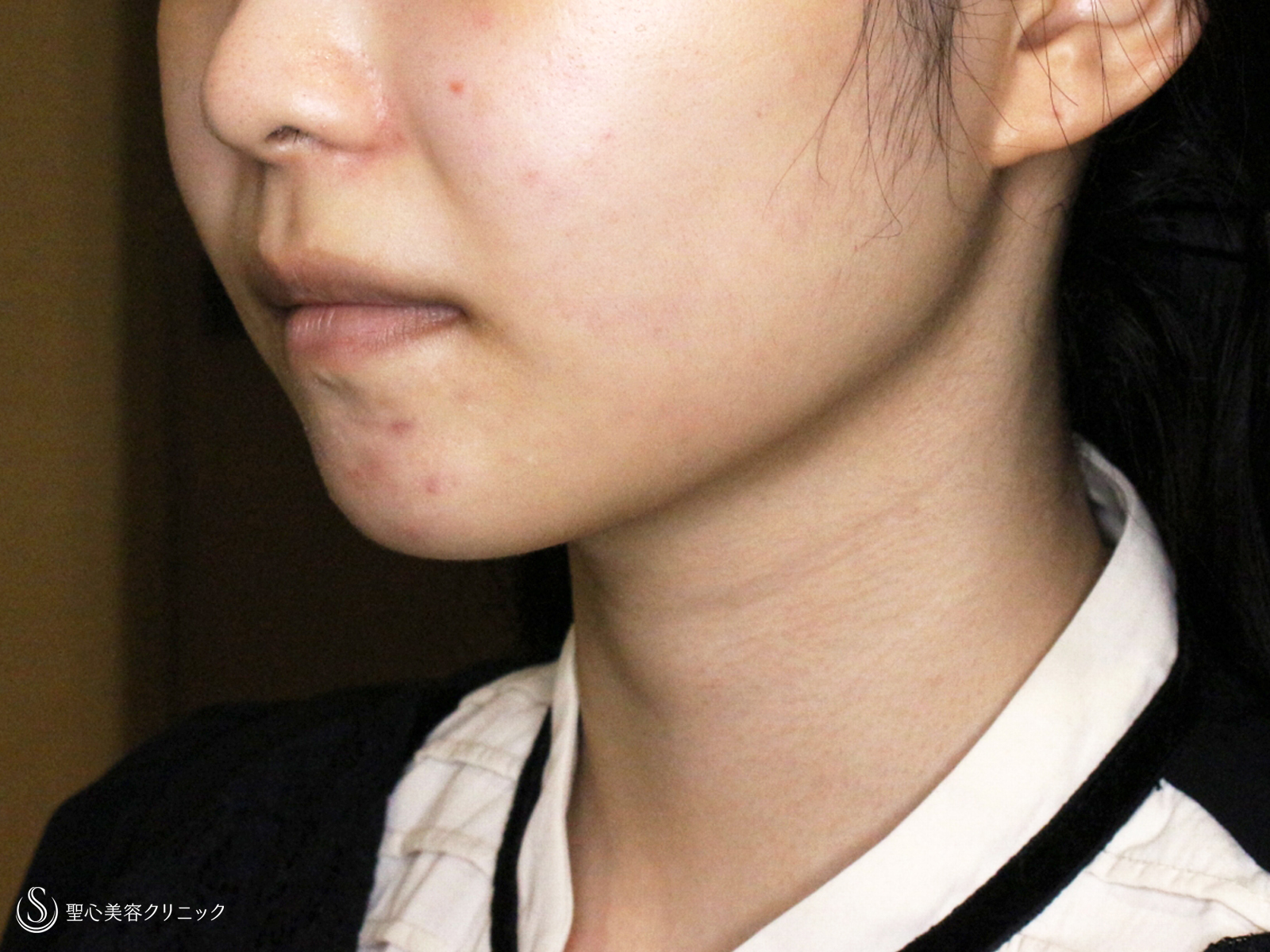 【20代女性・下ぶくれ＆二重あご解消】ベイザー脂肪吸引「頬＆あご下」（直後〜2ヶ月後） After 