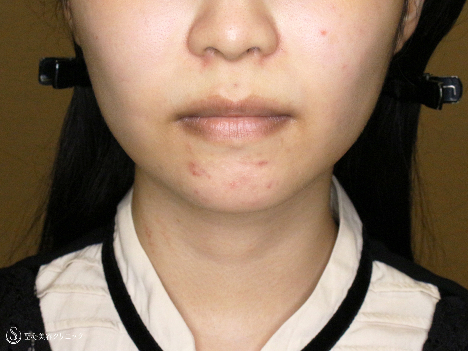 【20代女性・下ぶくれ＆二重あご解消】ベイザー脂肪吸引「頬＆あご下」（直後〜2ヶ月後） After 