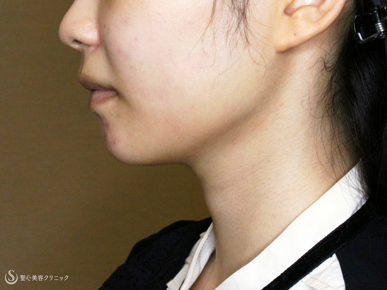 【20代女性・下ぶくれ＆二重あご解消】ベイザー脂肪吸引「頬＆あご下」（直後〜2ヶ月後） After 
