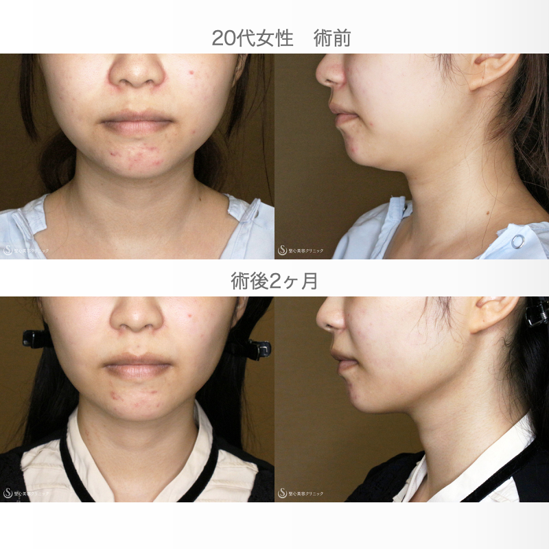【20代女性・下ぶくれ＆二重あご解消】ベイザー脂肪吸引「頬＆あご下」（直後〜2ヶ月後） After 