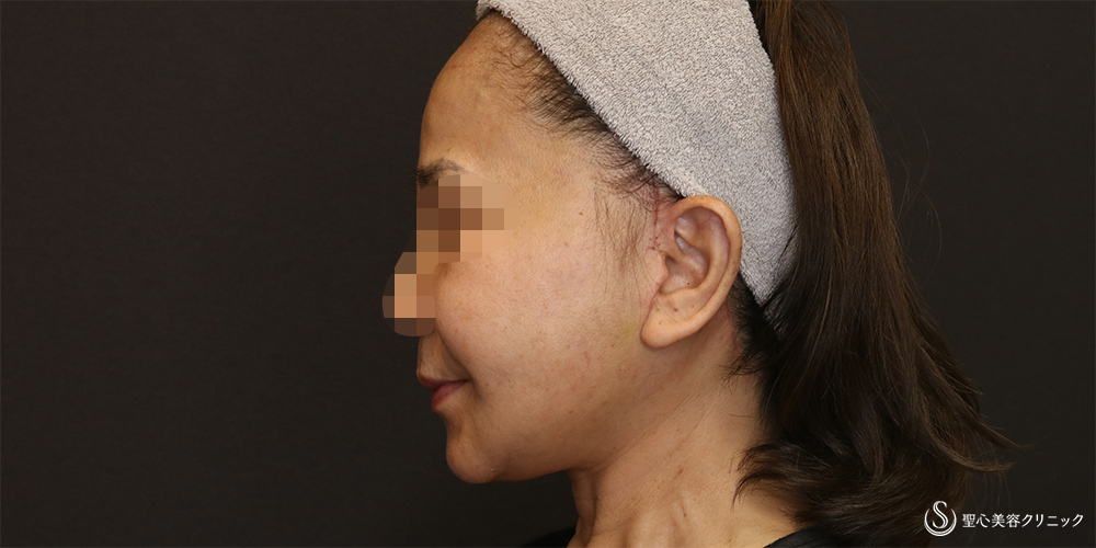 【50代女性・フェイスラインをスッキリ】フェイスリフト+脂肪吸引(頬+顎下)(術後3週間) After 