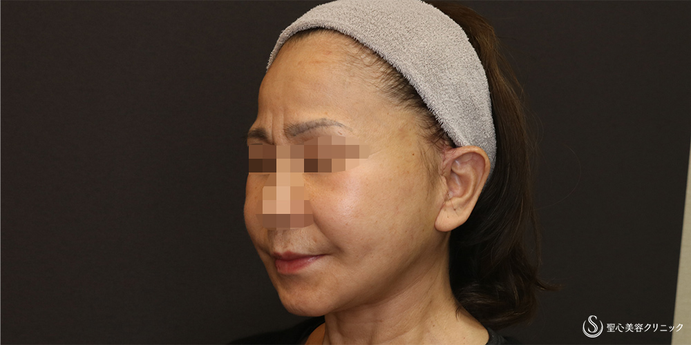 【50代女性・フェイスラインをスッキリ】フェイスリフト+脂肪吸引(頬+顎下)(術後3週間) After 