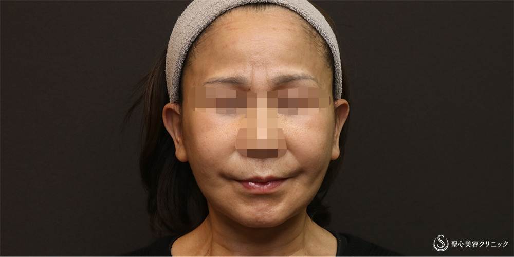 【50代女性・フェイスラインをスッキリ】フェイスリフト+脂肪吸引(頬+顎下)(術後3週間) After 