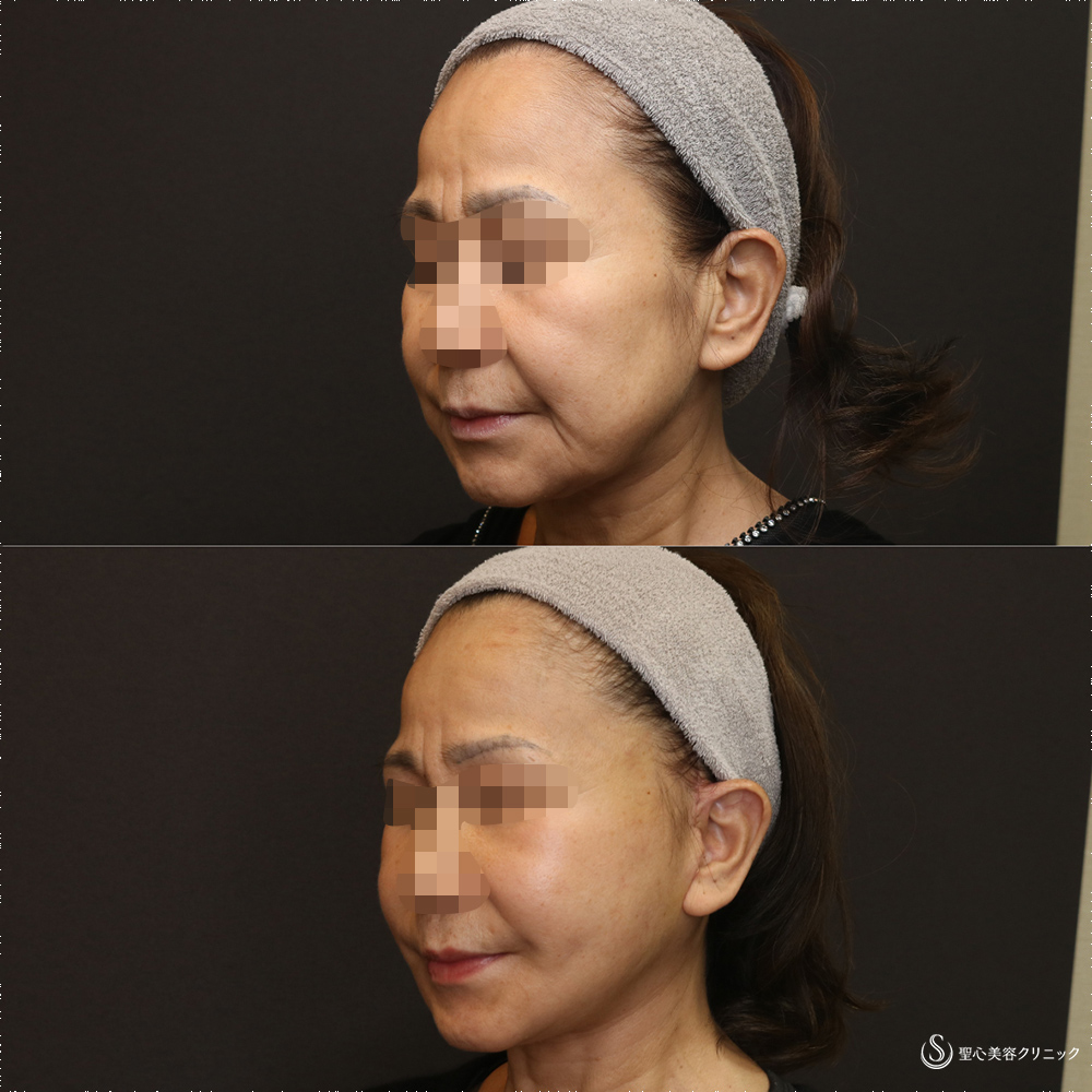 【50代女性・フェイスラインをスッキリ】フェイスリフト+脂肪吸引(頬+顎下)(術後3週間) After 