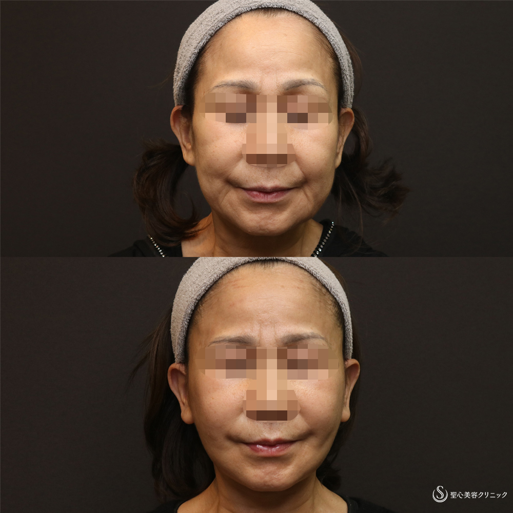 【50代女性・フェイスラインをスッキリ】フェイスリフト+脂肪吸引(頬+顎下)(術後3週間) After 