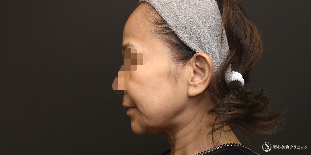 【50代女性・フェイスラインをスッキリ】フェイスリフト+脂肪吸引(頬+顎下)(術後3週間) Before 