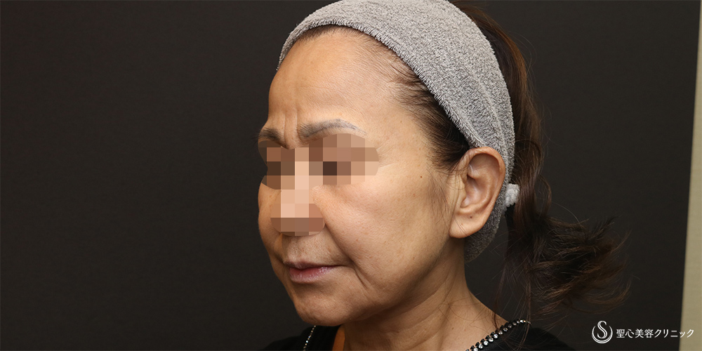 【50代女性・フェイスラインをスッキリ】フェイスリフト+脂肪吸引(頬+顎下)(術後3週間) Before 