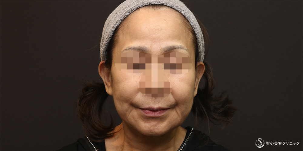 【50代女性・フェイスラインをスッキリ】フェイスリフト+脂肪吸引(頬+顎下)(術後3週間) Before 