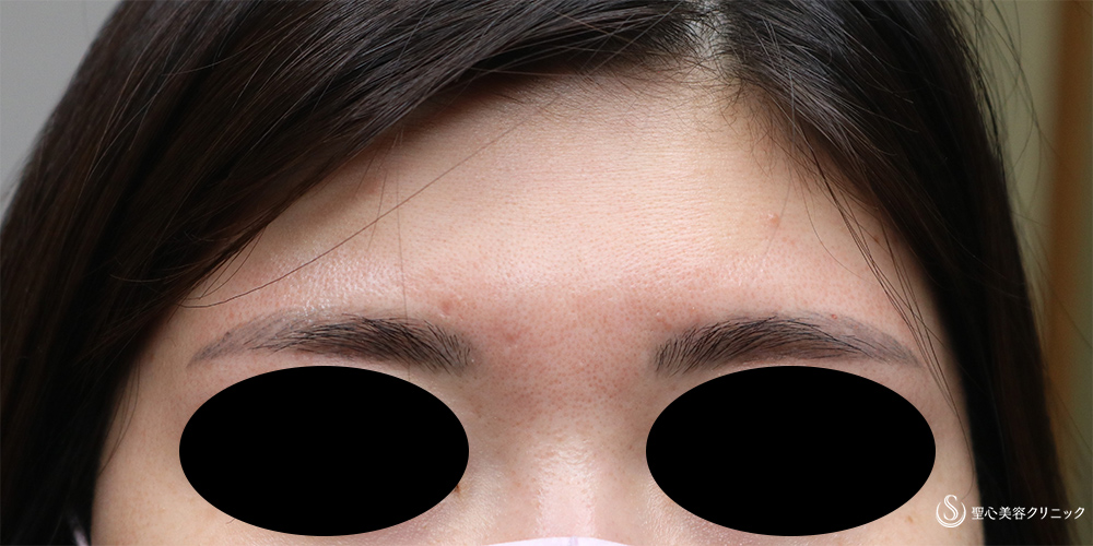 【30代女性・傷跡の改善】プレミアムPRP皮膚再生療法（1年後） Before 