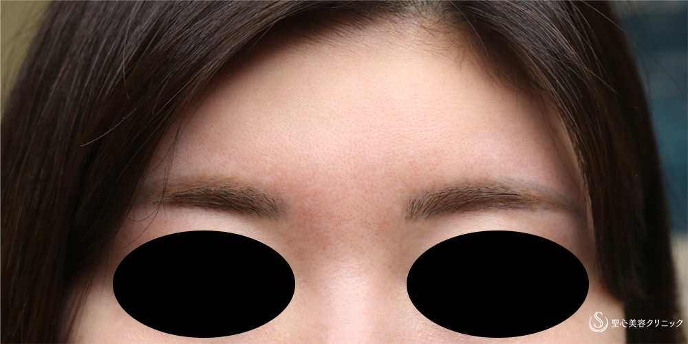 【30代女性・傷跡の改善】プレミアムPRP皮膚再生療法（1年後） After 