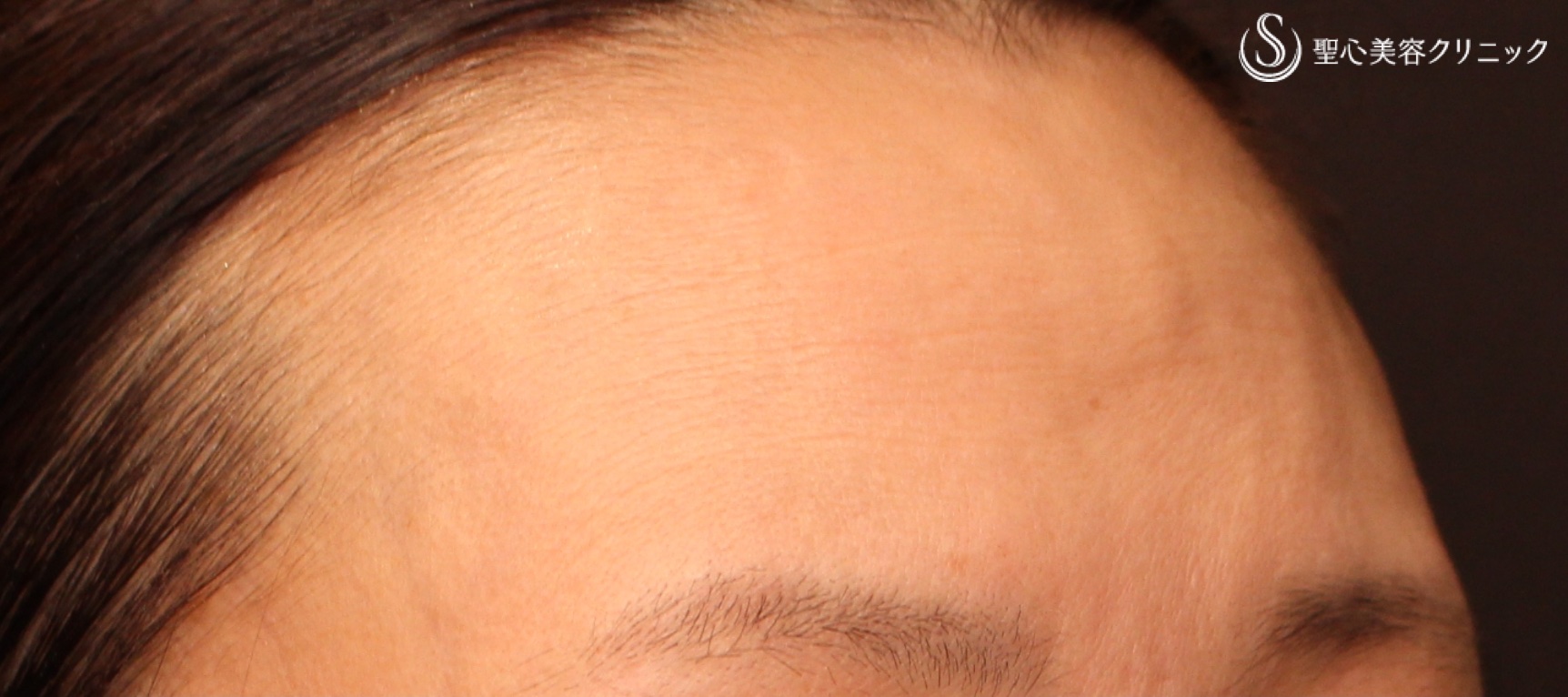 【50代女性・額のしわ】プレミアムPRP皮膚再生療法（処置後6か月） After 