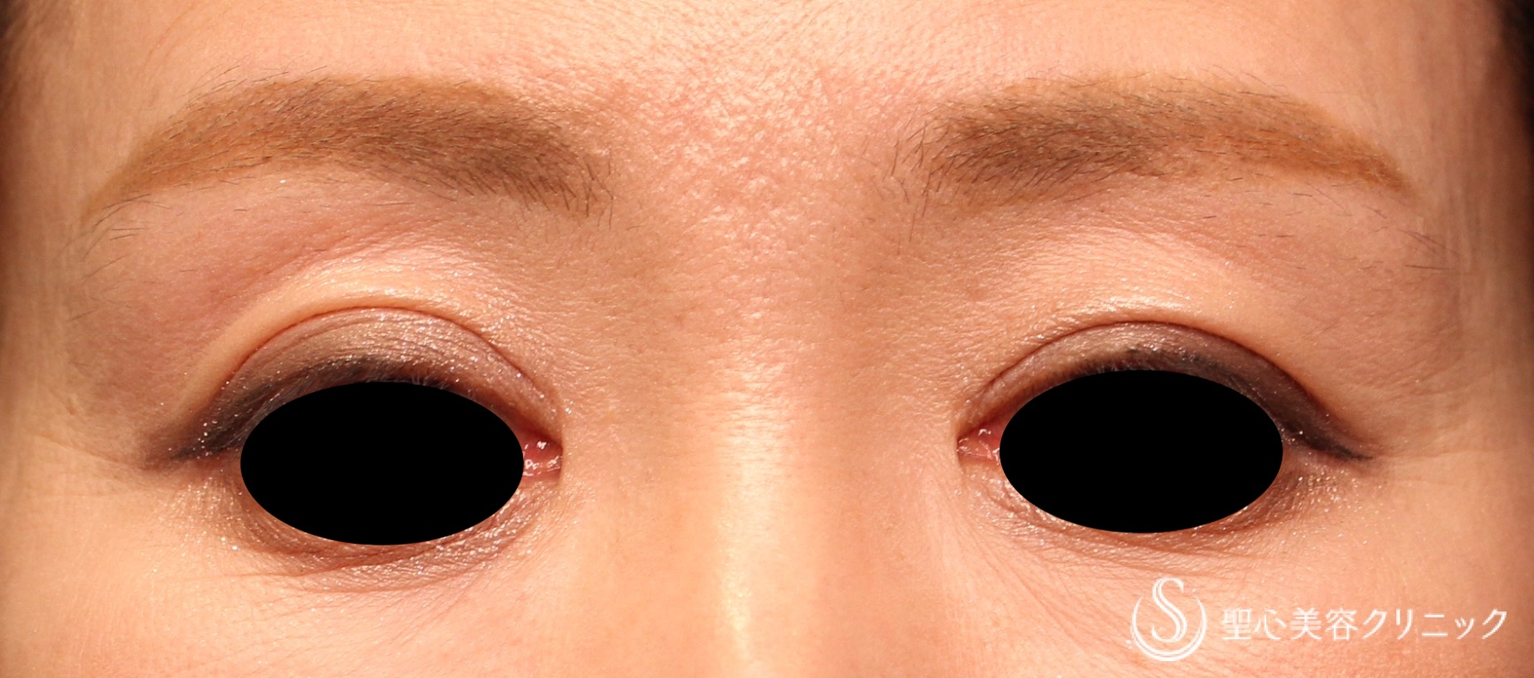 【50代女性・目の上の凹み】プレミアムPRP皮膚再生療法（処置後7か月） Before 