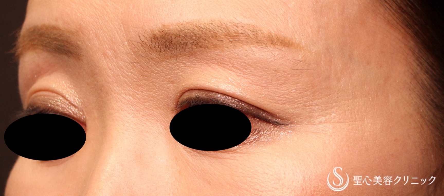 【50代女性・目の上の凹み】プレミアムPRP皮膚再生療法（処置後7か月） Before 