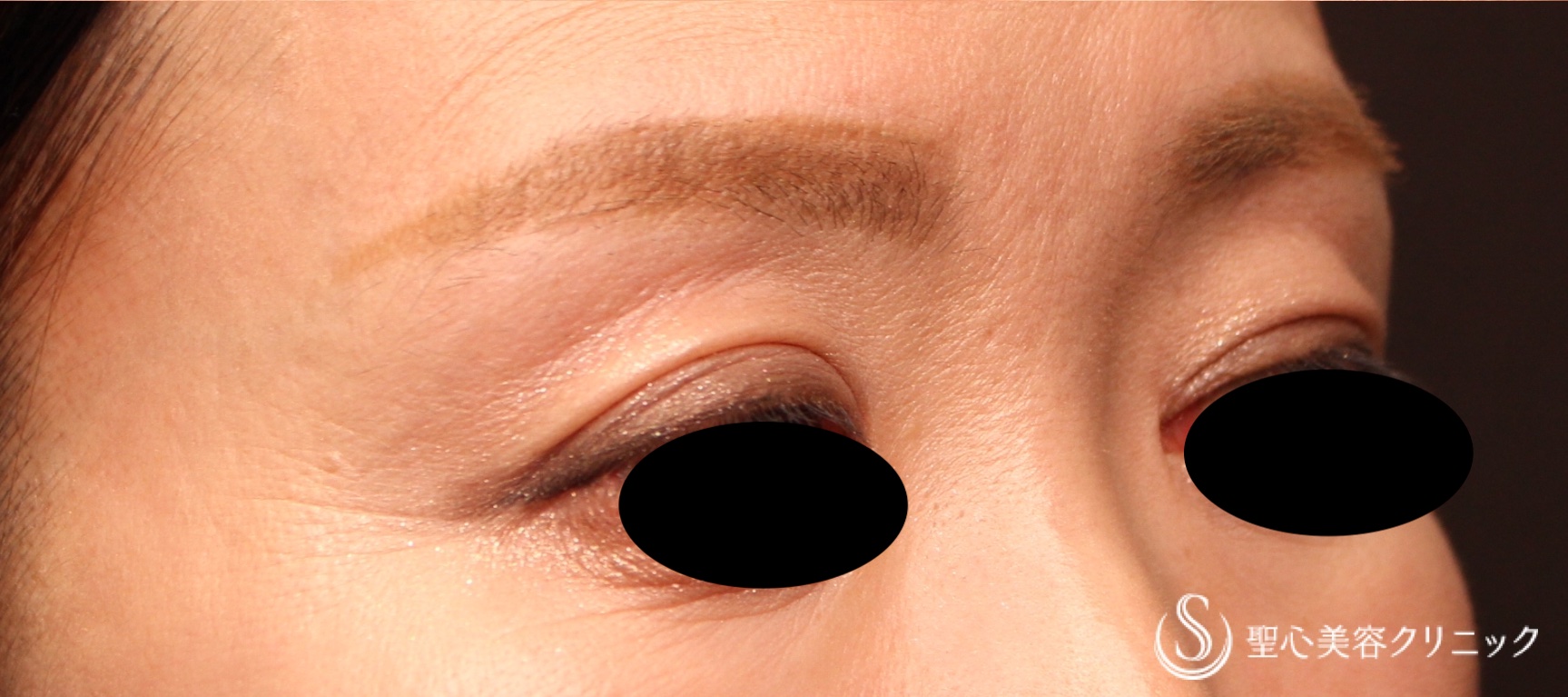 【50代女性・目の上の凹み】プレミアムPRP皮膚再生療法（処置後7か月） Before 