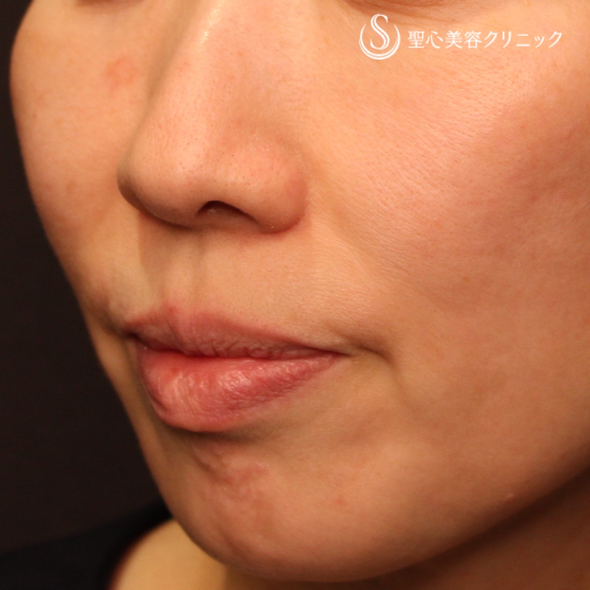 【50代女性・ほうれい線、マリオネットライン】プレミアムPRP皮膚再生療法（処置後7か月） After 