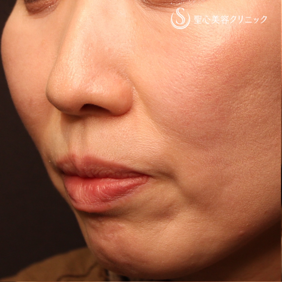 【50代女性・ほうれい線、マリオネットライン】プレミアムPRP皮膚再生療法（処置後7か月） Before 