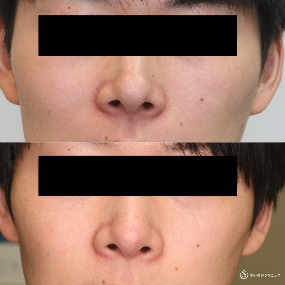 【30代男性・すっきりシャープな鼻先】鼻尖縮小＋鼻尖形成(耳介軟骨移植)（4ヵ月後） After 