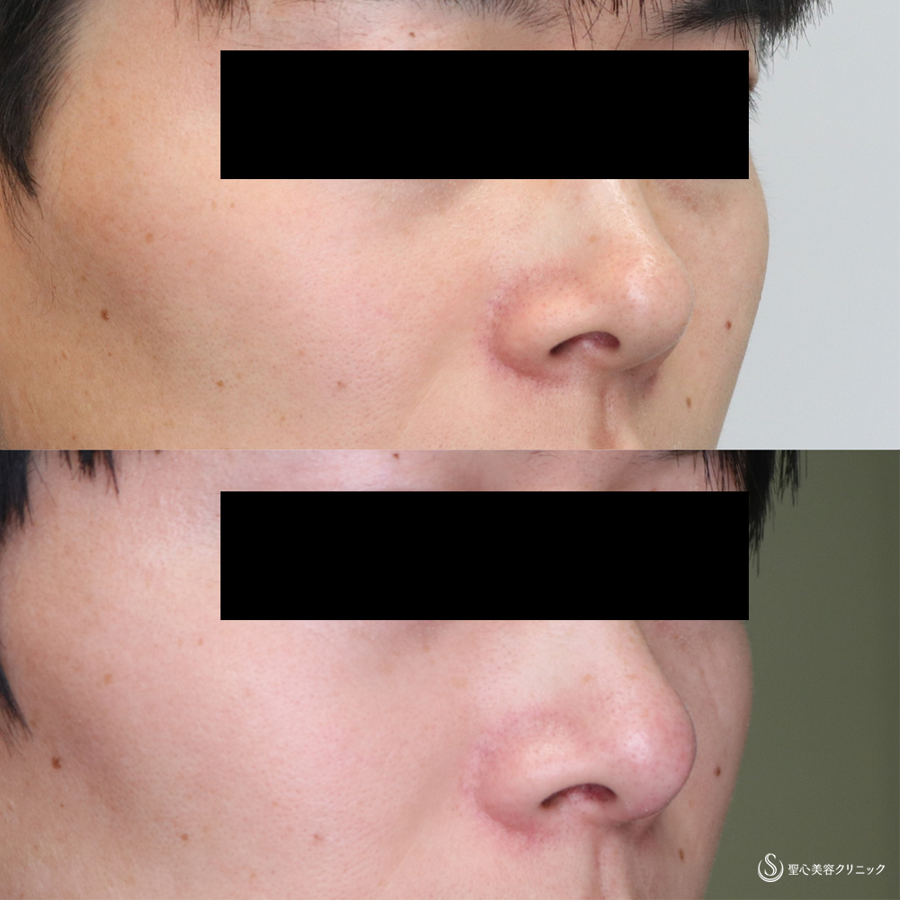 【30代男性・すっきりシャープな鼻先】鼻尖縮小＋鼻尖形成(耳介軟骨移植)（4ヵ月後） After 