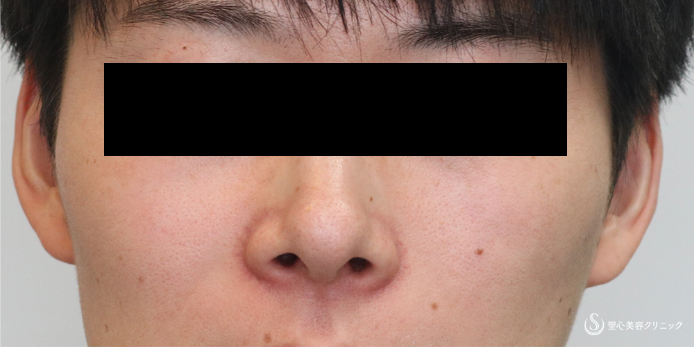 【30代男性・すっきりシャープな鼻先】鼻尖縮小＋鼻尖形成(耳介軟骨移植)（4ヵ月後） Before 