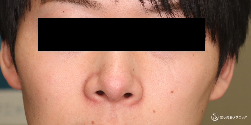 【30代男性・すっきりシャープな鼻先】鼻尖縮小＋鼻尖形成(耳介軟骨移植)（4ヵ月後） After 