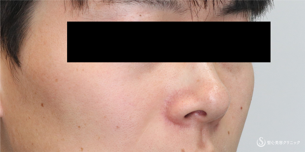 【30代男性・すっきりシャープな鼻先】鼻尖縮小＋鼻尖形成(耳介軟骨移植)（4ヵ月後） Before 