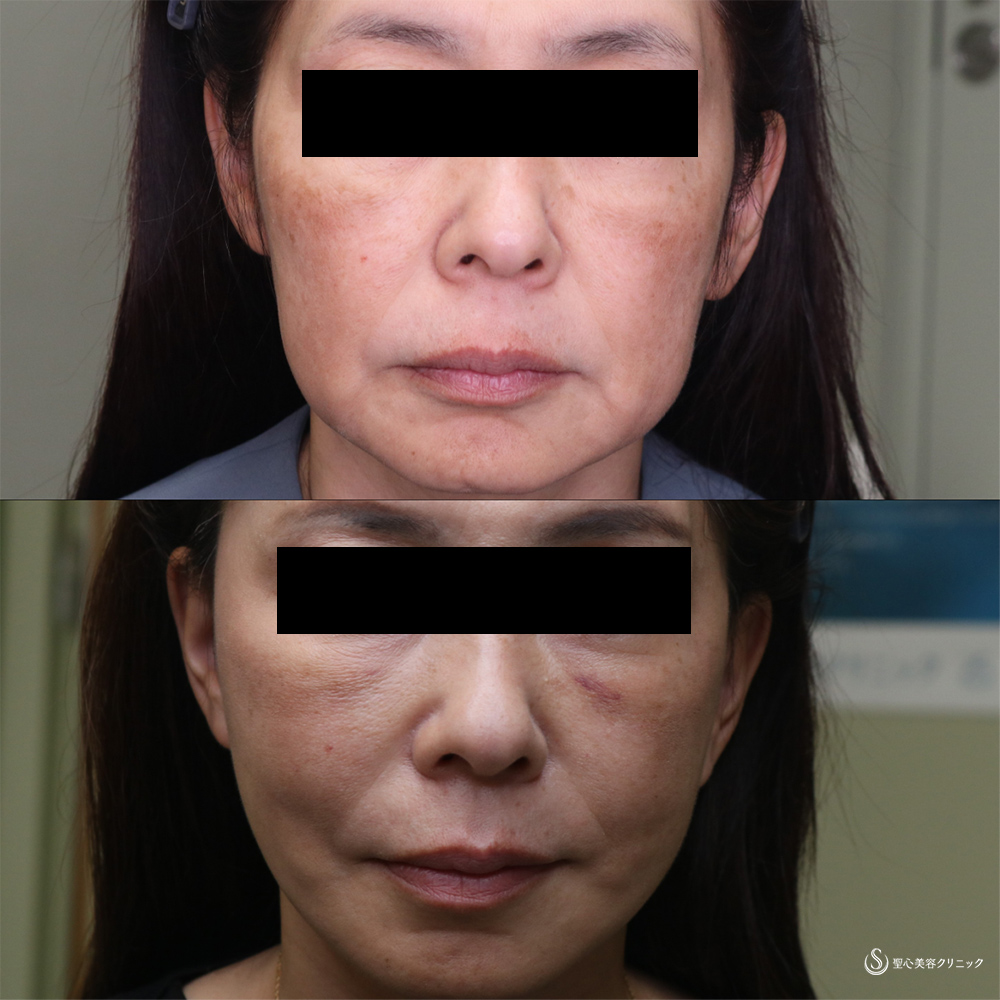 【60代女性・フェイスリフトで見た目年齢マイナス10歳】フェイスリフト+頬・顎下の脂肪吸引(1ヵ月後） After 
