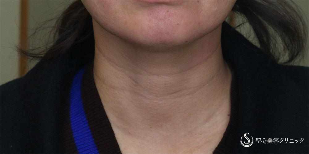 【50代女性・注射で手軽に首のしわ取り】プレミアムPRP皮膚再生療法(6ヵ月後) Before 