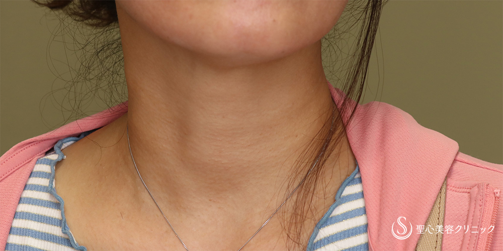 【50代女性・注射で手軽に首のしわ取り】プレミアムPRP皮膚再生療法(6ヵ月後) After 