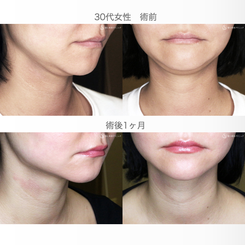 【30代女性・二重あご解消】脂肪吸引注射「あご下」（術直後〜1ヶ月後） After 