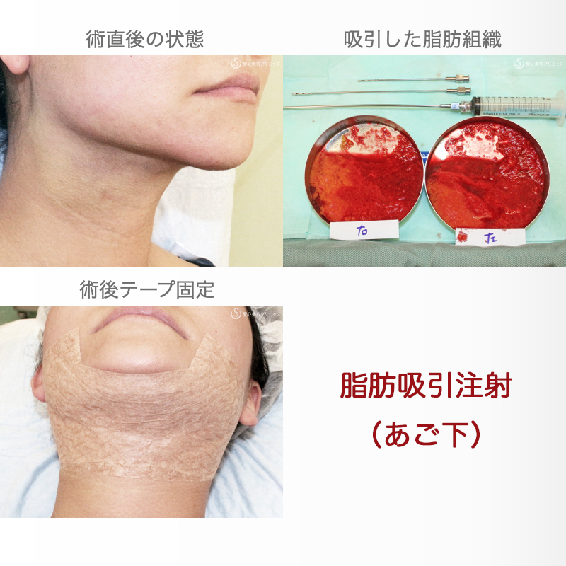 【30代女性・二重あご解消】脂肪吸引注射「あご下」（術直後〜1ヶ月後） After 
