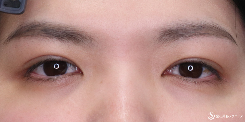 【20代女性・二重の左右差を改善】マイクロメソッド+α法(2点留め)・目上切開(右のみ)(術後1ヵ月後) After 