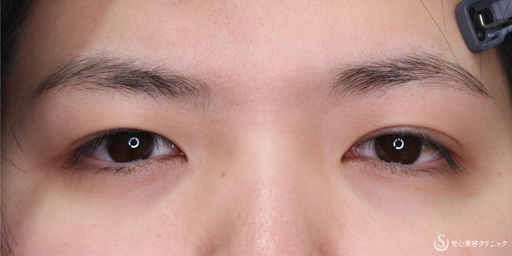 【20代女性・二重の左右差を改善】マイクロメソッド+α法(2点留め)・目上切開(右のみ)(術後1ヵ月後) Before 