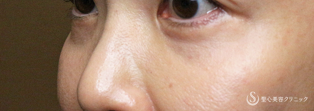 【40代女性・目の下のクマ＆タルミ若返り治療】表ハムラ+α法 単独例（直後〜1年6ヶ月後） After 