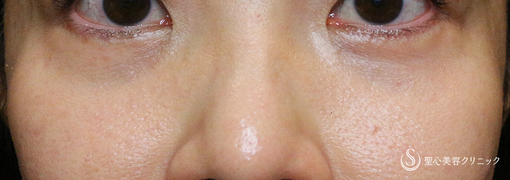 【40代女性・目の下のクマ＆タルミ若返り治療】表ハムラ+α法 単独例（直後〜1年6ヶ月後） After 