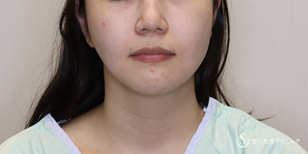 【20代女性・シャープなフェイスラインに】脂肪吸引(顎下)(1か月後) Before 